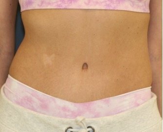 Tummy Tuck 211 - after - front