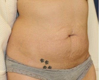 Tummy Tuck 211 - before - oblique