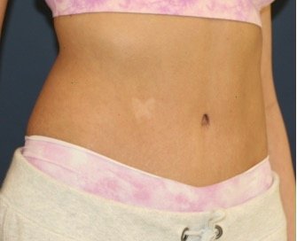 Tummy Tuck 211 - after - oblique