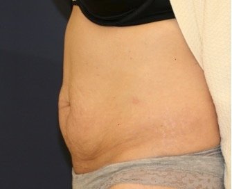 Tummy Tuck 211 - before - side