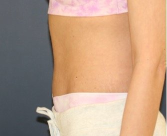 Tummy Tuck 211 - after - side