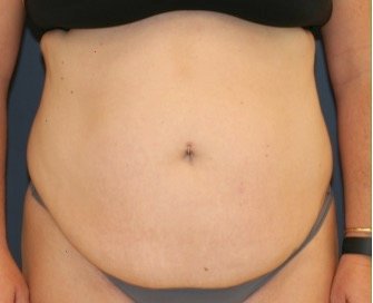 Tummy Tuck 212 - before - front
