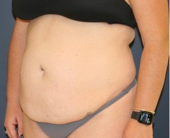 Tummy Tuck 212 - before - oblique