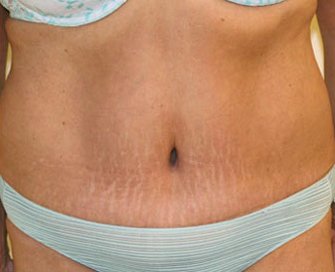 Tummy Tuck Case 6 - after - front