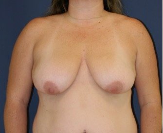 Breast Lift 303 - before - front