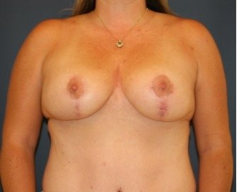 Breast Lift 303 - after - front