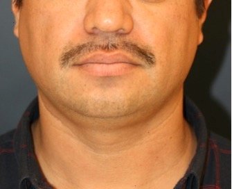 Neck Liposuction and Chin Implant 202 - before - side