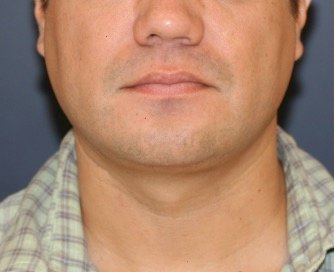 Neck Liposuction and Chin Implant 202 - after - side