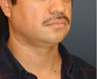 Neck Liposuction and Chin Implant 202 - before - oblique