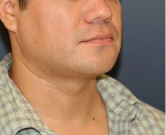 Neck Liposuction and Chin Implant 202 - after - oblique