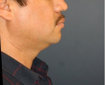 Neck Liposuction and Chin Implant 202 - before - front