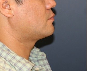 Neck Liposuction and Chin Implant 202 - after - front