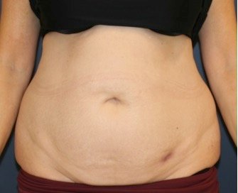 Tummy Tuck 213 - before - front
