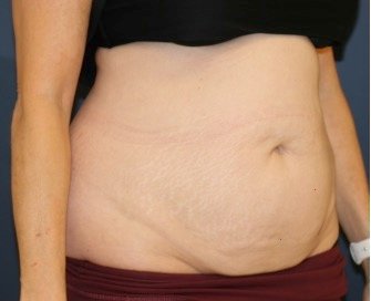 Tummy Tuck 213 - before - oblique