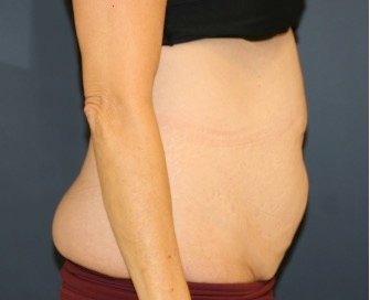 Tummy Tuck 213 - before - side