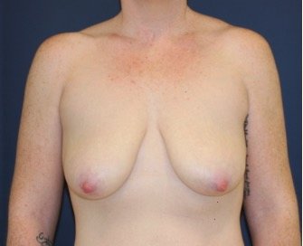 Breast Lift 304 - before - front