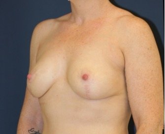 Breast Lift 304 - after - oblique