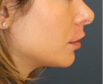 Chin Implant 201 - before - front