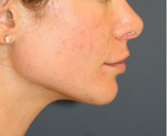 Chin Implant 201 - after - front