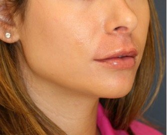 Chin Implant 201 - before - oblique