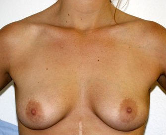 Breast Augmentation Case 34 - before - front