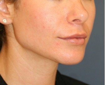 Chin Implant 201 - after - oblique