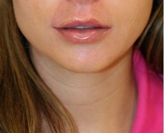 Chin Implant 201 - before - side