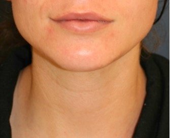 Chin Implant 201 - after - side