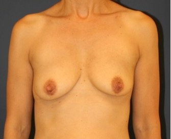 Breast Augmentation Lift 55 - before - front