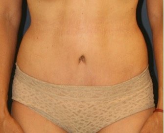 Tummy-Tuck 214 - after - front