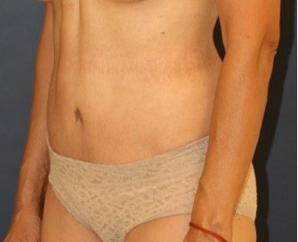 Tummy-Tuck 214 - after - oblique