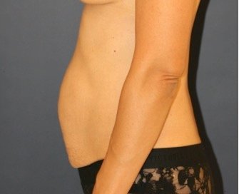 Tummy-Tuck 214 - before - side