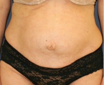 Tummy Tuck 215 - before - front