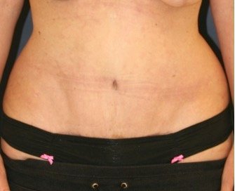 Tummy Tuck 215 - after - front