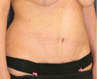 Tummy Tuck 215 - after - oblique