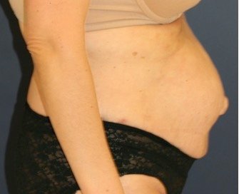 Tummy Tuck 215 - before - side