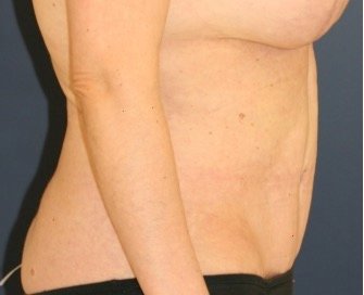 Tummy Tuck 215 - after - side