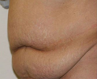 Tummy Tuck Case 6 - before - angle