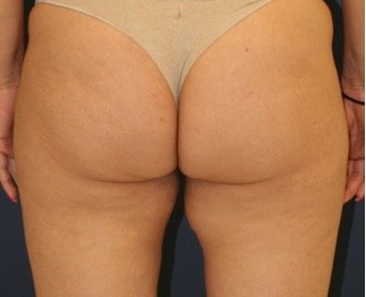 Liposuction Inner Thighs 204 - before - front