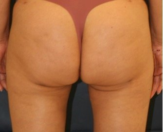 Liposuction Inner Thighs 204 - after - front