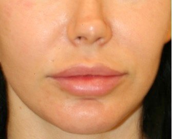 Lip lift 202 - before - front