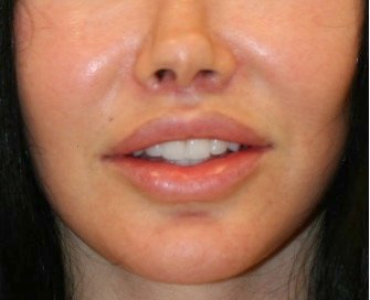 Lip lift 202 - after - front