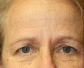 Blepharoplasty Under Browlift 101 - before - front