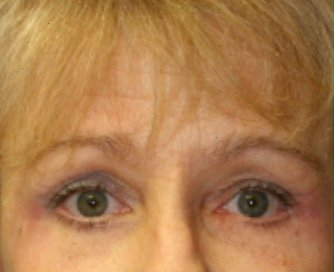Blepharoplasty Under Browlift 101 - after - front
