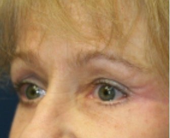 Blepharoplasty Under Browlift 101 - after - oblique