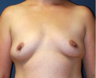 Breast Augmentation 137 - before - front