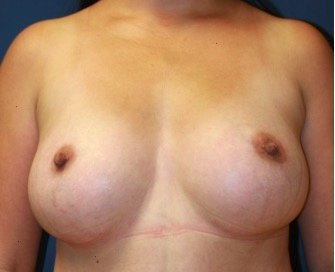 Breast Augmentation 137 - after - front