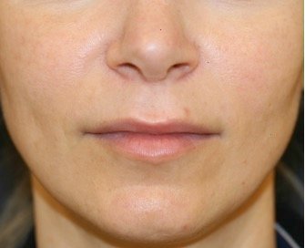 Upper Lip Lift 203 - before - front