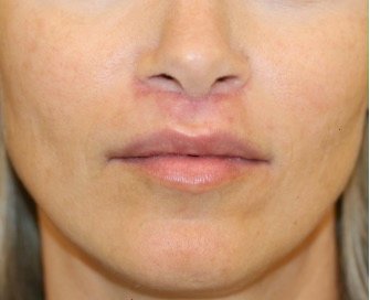 Upper Lip Lift 203 - after - front