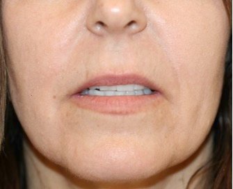 Corner Lip Lift 204 - before - front